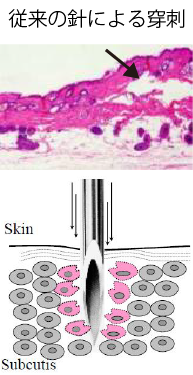 従来の針による穿刺