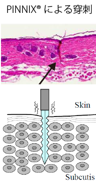 PINNIXRによる穿刺
