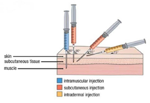 intradermal injection